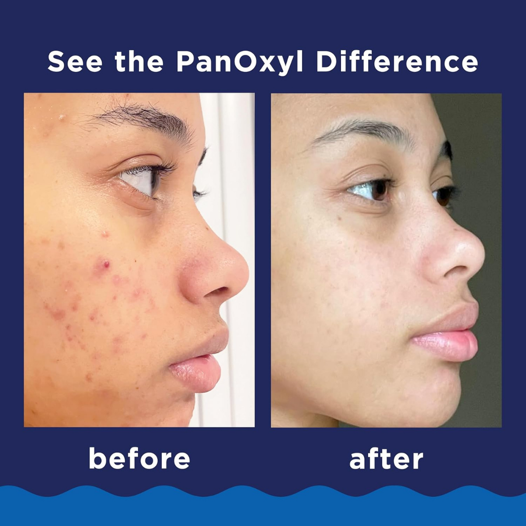 PanOxyl Limpiador Facial para Acné 156g